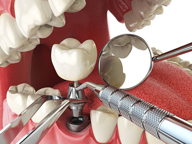 Best Emergency Tooth Extraction in Ben Lomond, CA